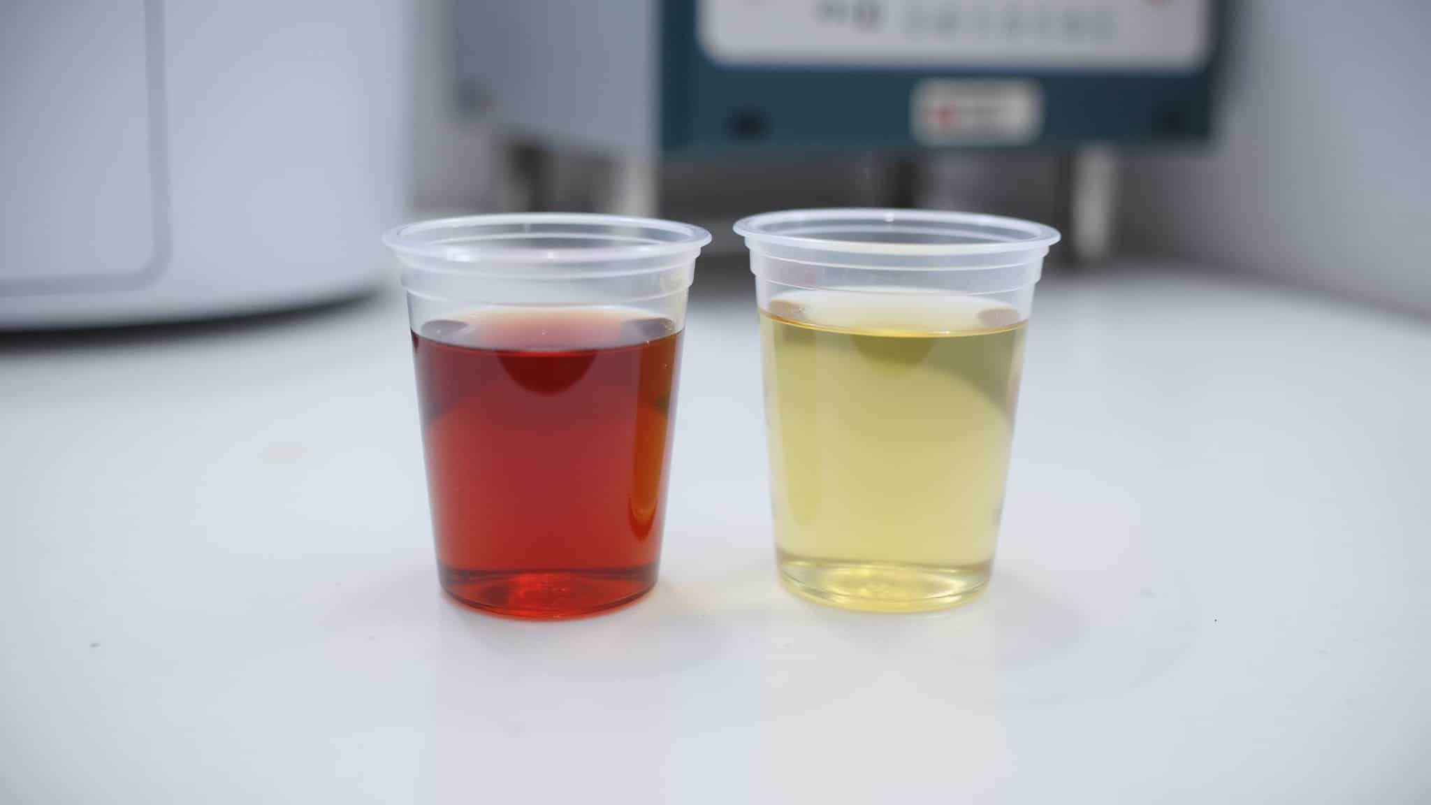 blood in urine causes