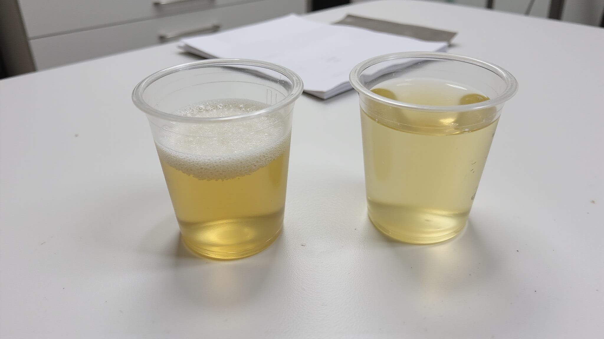 foamy urine causes and alarm